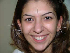 Şeker hastalarına akupunktur desteği