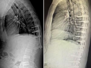 Hem kamburluğu giderildi hem de sağlığına kavuştu