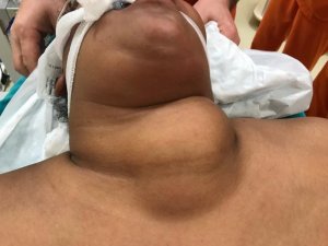 Somalili hastanın boğazından 450 gramlık nodül çıkarıldı