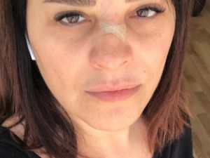 Ünlü şarkıcı Reyhan Karaca’nın burnu kırıldı