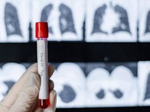 Covid-19 sonrası akciğerlerde kalıcı hasar endişesi