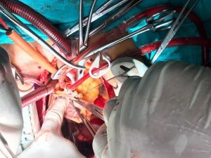 Afyonkarahisar’da kalbe yerleşen 5 santimlik tümör ameliyatla alındı