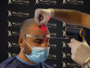 Million Hair Center CEO’ su Fatih Köse: ’’Saç ekiminin en önemli noktaları ön saç çizgisi ve doğal görünümdür’’