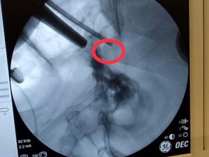 Hastanın beyindeki tümörü burun deliğinden çıkardılar