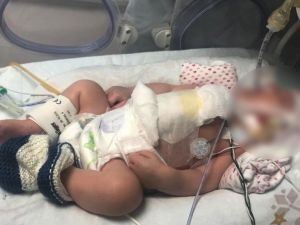 Yapışık ikizler 7 saat süren operasyonun ardından ayrıldılar