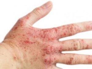 Sizde de bu belirtiler varsa, Rozasea olabilirsiniz