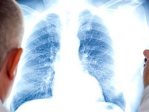 KOAH hastaları COVID-19’u 5 kat daha ağır geçiriyor