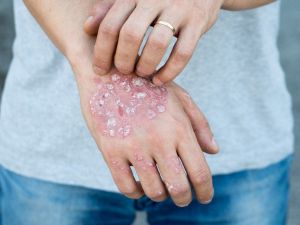 “Soğuk hava psoriasis’i şiddetlendiriyor”