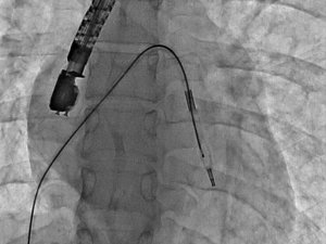 Mitral balon operasyonu adım adım kaydedildi