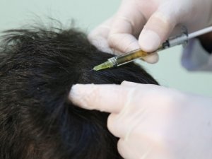 Cumhuriyet Üniversitesi bu yöntemle kelliği önleyecek