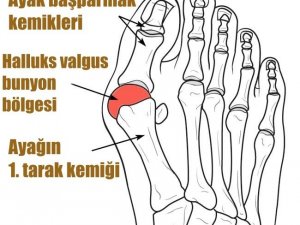 Dar ve sivri burunlu ayakkabılar şekil bozukluğuna sebep oluyor
