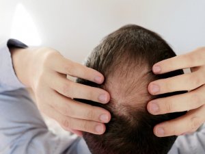 Saçları korona değil stres döküyor