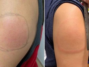 ABD’de Moderna aşısı yaptıran kişilerde yan etki: "Covid-19 kolu"