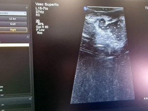 Cumhurbaşkanı Erdoğan’ın açılışını yapmıştı, Hibrit Ameliyathanede ilk ameliyat gerçekleştirildi