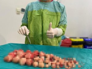 Karın ağrısı yaşayan hastanın rahminden 72 miyom çıkarıldı