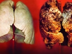 Beta karoten akciğer kanseri riskini arttırıyor