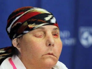 ABD’de iki kez yüz nakli yapılan kadın, ilk kez yeni yüzünü gösterdi