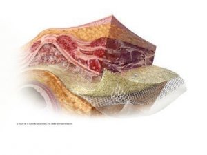 Gore Synecor Intraperitoneal biyomateryali piyasaya sürdü