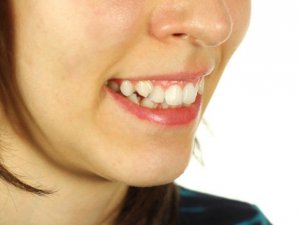 Ağızdan nefes almak, diş yapısını bozabilir