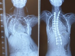 Mersinli skolyoz hastası Medine, ameliyatla yeniden doğdu