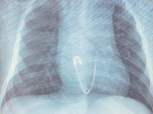 5 aylık bebeğin yuttuğu çengelli iğne operasyonla çıkarıldı