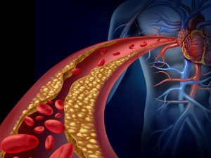 Yüksek kolesterollü hastalara yeni umut: Kolesterol aşısı