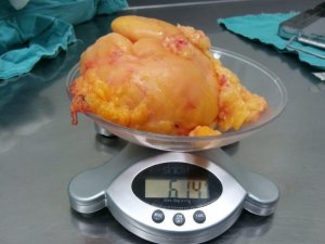 Kitle sebebi ile başvurdu dizinden 614 gram yağ bezesi çıkartıldı
