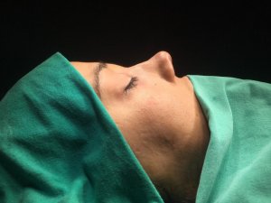 Kaburga kıkırdağından yeni burun ucu