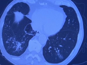 2. doz Covid-19 aşısı olan kişilerin gerçek yaşam sonuçları