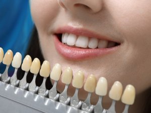 Dişleri beyazlatmada sosyal medya önerileri sağlığınıza zarar verebilir