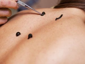 Sülük Tedavisi (Hirudoterapi) Nedir?