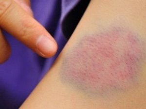 Çocuğunuzun cildinde kolay oluşan morluklara dikkat