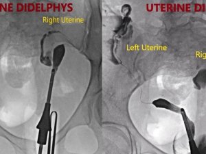 Uzun zaman bebek hasreti çeken anne ve babalar dikkat