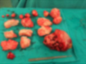 Şişkinlik sandı karnından 1,5 kilo miyom çıktı