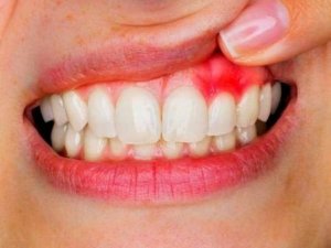 Dişeti hastalıkları sistemik hastalıkların belirtisi olabilir