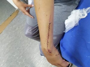 Yüzü ve kollarında kesikler oluşan çocuğa 70 dikiş atıldı