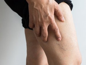 Varis tedavisinde modern yöntemler