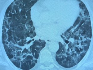 Korona virüs geçiren hastalarda yeni klinik bulgular: "Uzamış Covid ve post Covid"