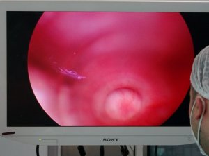 Sancaktepe’de Pektus Farkındalık Haftasına dikkat çekmek için 5 hasta ameliyat edildi