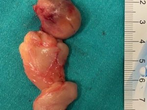 SANKO Üniversitesi Hastanesi’nde başarılı ameliyat