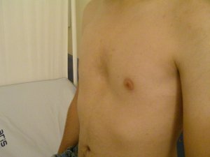 Göğüs kafesindeki çukurluk, solunumu ve kalbi zor durumda bırakabilir