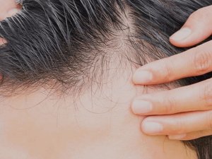 Manuel Saç Ekimi Operasyonu Nasıl Gerçekleştirilir?