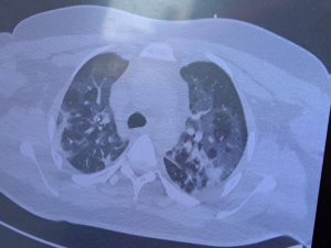 Aşısız gençler ve delta varyantı hasta profilini değiştirmeye başladı