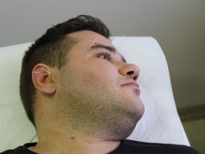 Fazla kilolara karşı akupunktur