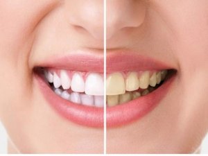 Bilinçsiz yapılan dişlerde ağartma işlemi kalıcı hasarlara neden oluyor