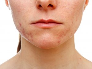 Cildinizi ‘maskne’ye karşı korumanız mümkün