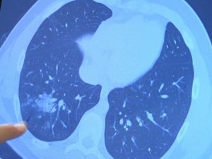 Aşı olmayan 14 yaşındaki çocukta ciddi akciğer tutulumları görüldü