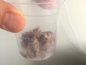 Yemek borusundan 6 santimlik et parçası çıktı