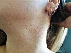 Sıcak havalarda ter alerjisine dikkat