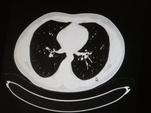 Aşılı ve aşısız olarak koronaya yakalanan 2 gencin akciğer tomografisi korkunç gerçeği gözler önüne serdi